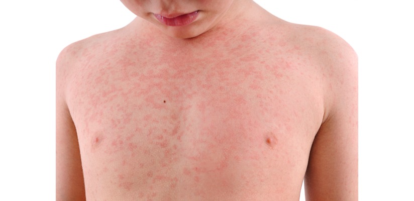 Viral Rash.jpeg